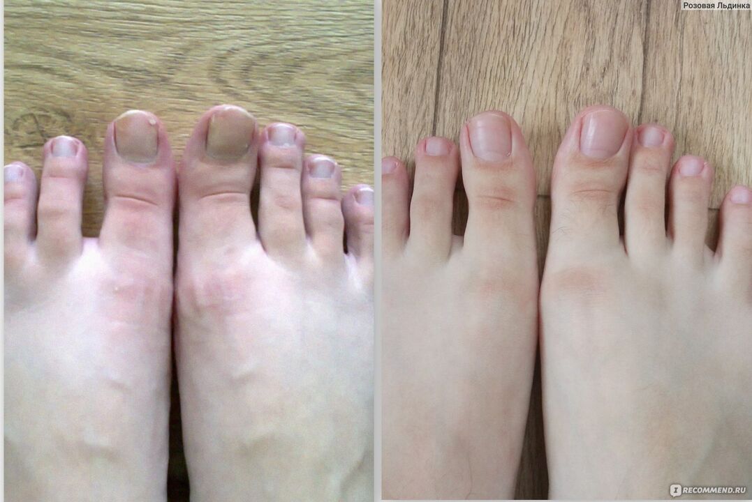 Before and after fungal treatment with Fungostop Plus cream