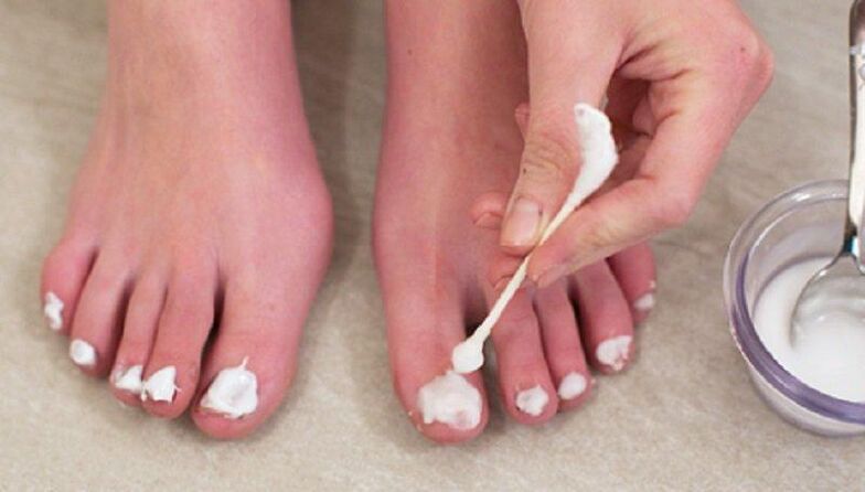 Traditional treatment of nail fungus