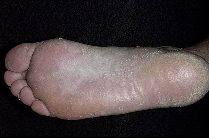 The mushroom of the foot
