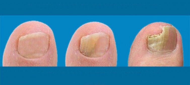 The process of developing nail fungi
