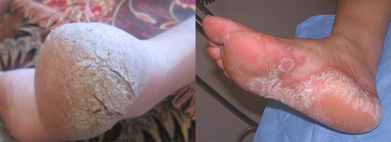 Legs affected by mushrooms