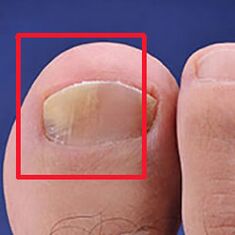 Mikosis or nail fungus