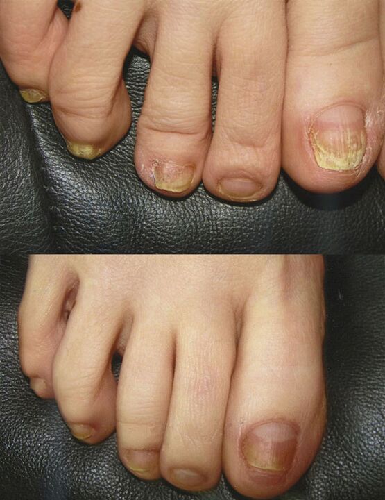 The use of boric acid to treat fungi