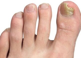 Symptoms of nail fungus