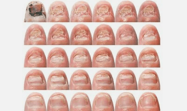 What does the nail fungus look like