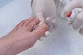 treatment of nail fungus