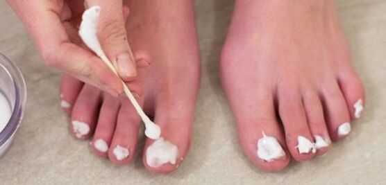treatment of nail fungus with ointment