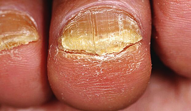 fungus developed on toenails