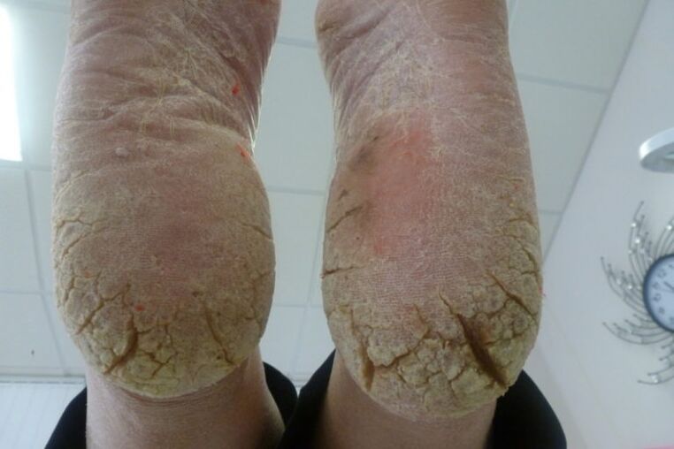 Deep cracks in the skin of the feet with advanced forms of fungi