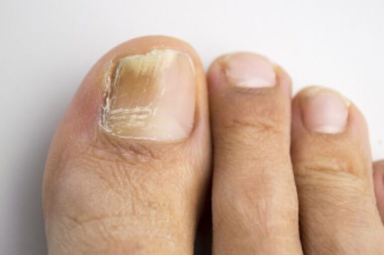 Fungal nail infection
