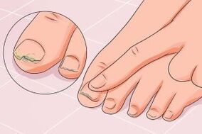 nail fungus infection