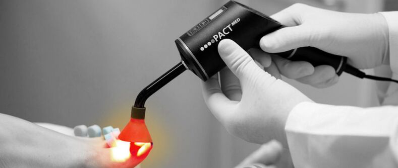 laser treatment of toenail fungus