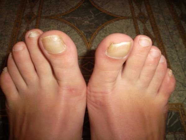 Fungal infection of the big toenails