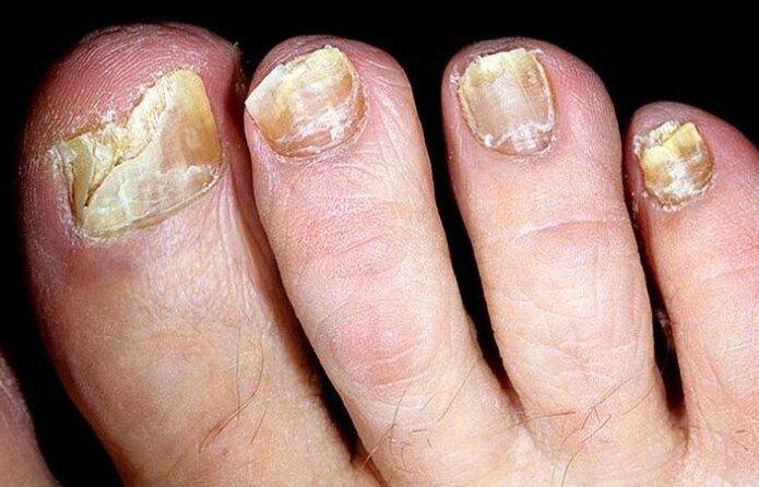 Advanced nail fungus that requires complex treatment