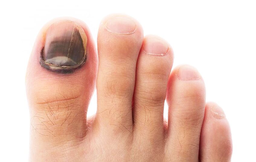 Fungal infection of the nail plate on the toe